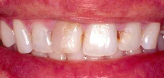 Cosmetic Veneers