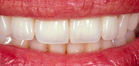 Cosmetic Veneers