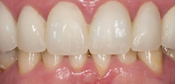 Cosmetic Veeners to Enhance Smile