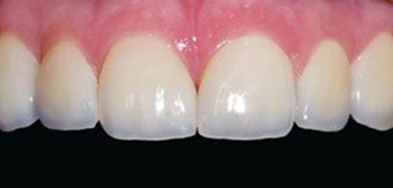 Gap in teeth