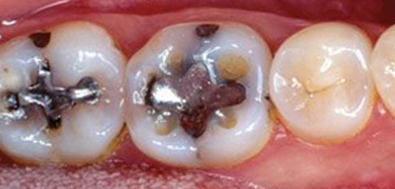 Tooth Colored Composite
