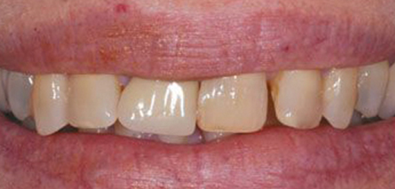 Veneers lay on Top of Existing 