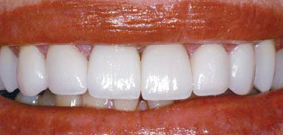 Veneers lay on Top of Existing 