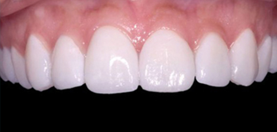 Veeners Whitening