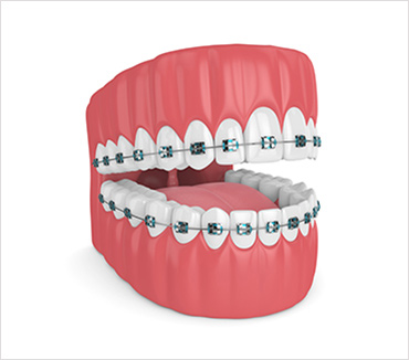 Affordable Braces Treatment  Clear/Ceramic/Lingual Braces