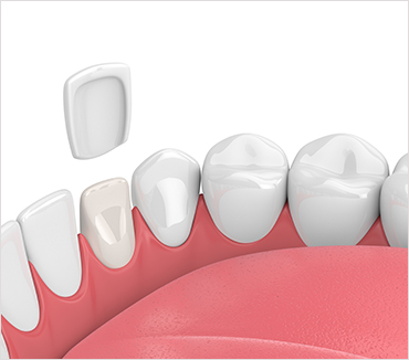 Dental Veneers