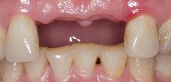 Missing Teeth Replaced by Bridge