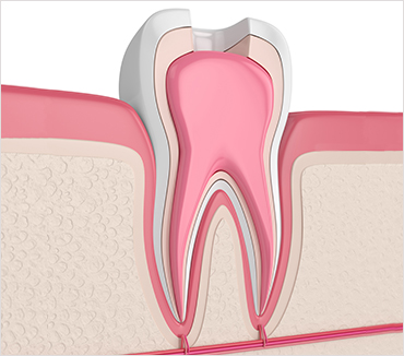 Root Canals