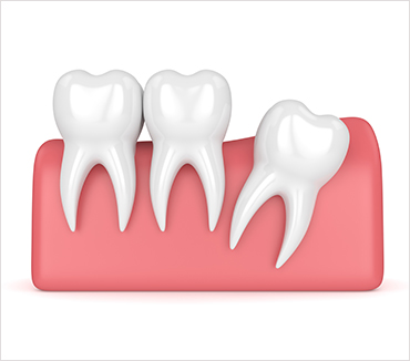 Wisdom Tooth Extraction