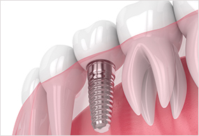 Dental implants