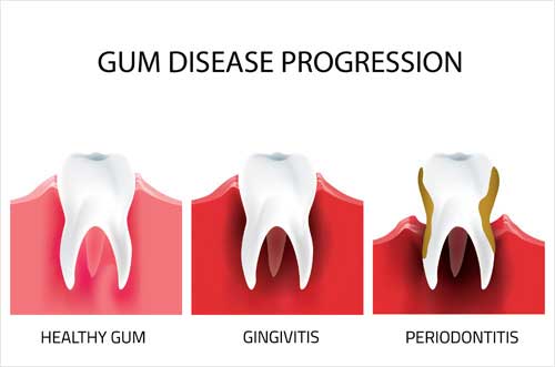 Gum Disease Progression