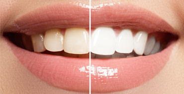 Is Teeth Whitening Safe