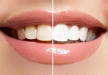 Is teeth whitening safe (and how does it impact your teeth)?