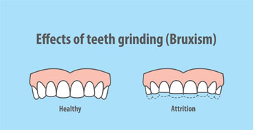 Bruxism: How does it affect your dental health