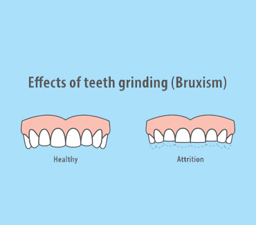 Bruxism: How does it affect your dental health