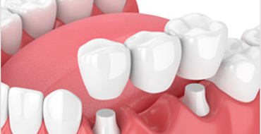 Dental Crowns and Tooth Bridges
