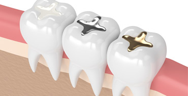 Types of Dental Filling