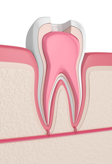 What Are Symptoms of a Root Canal Infection?
