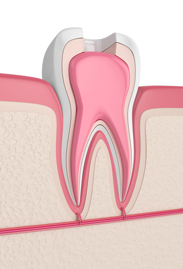 What Are Symptoms of a Root Canal Infection?