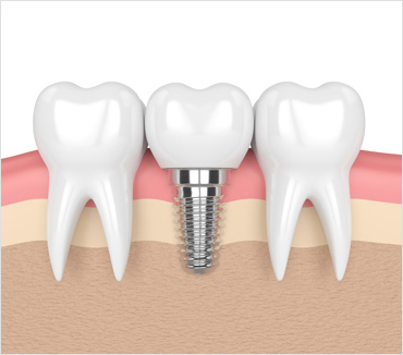 Dental Implants Inner Image