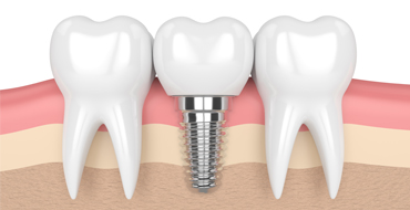 Dental Implants Thumbnail Image