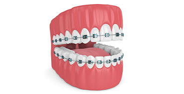 Braces Blog Image