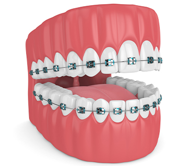 Braces