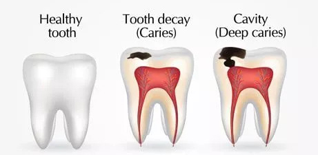 Cavities Image