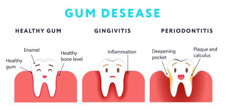 Gum Disease Image