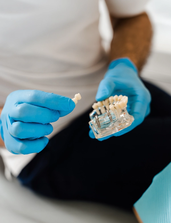 dental-implants-3