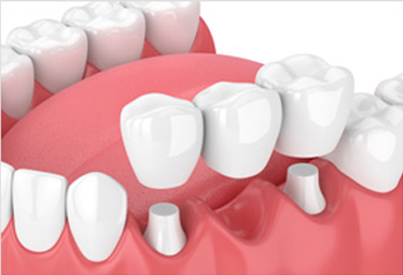 Dental crowns and tooth bridges