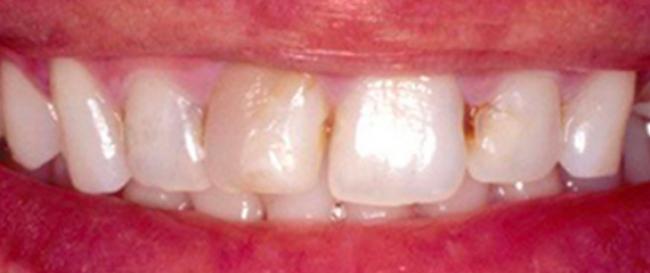 Cosmetic Veneers