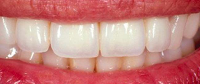 Cosmetic Veneers