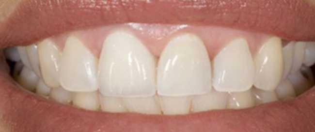 Replacement Crown to all Porcelain