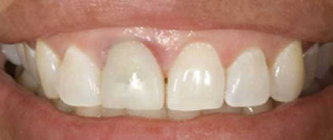 Replacement Crown to all Porcelain