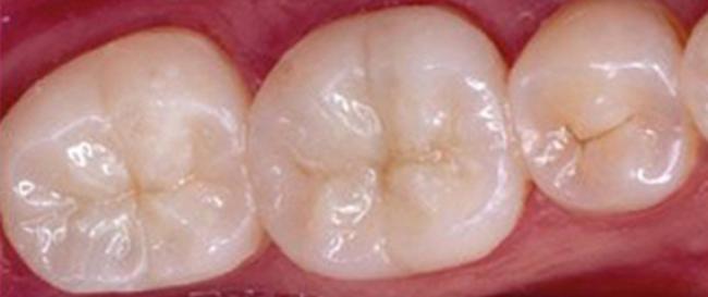 Tooth Colored Fillings