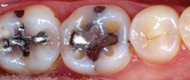 Tooth Colored Composite