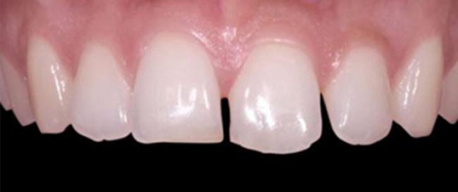 Veeners Whitening