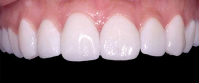 Veeners Whitening